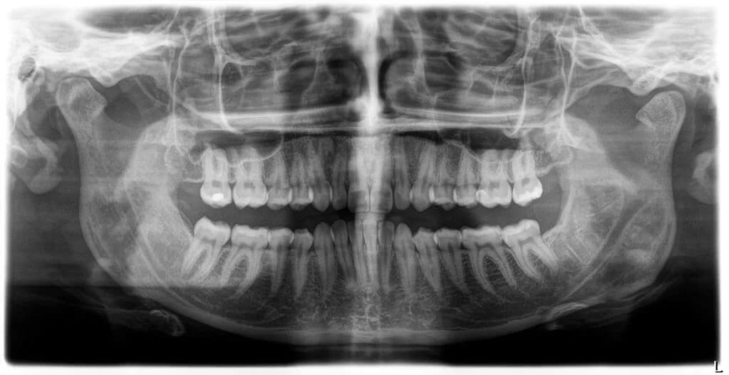 Digitale Röntgendiagnostik Panoramaaufnahme