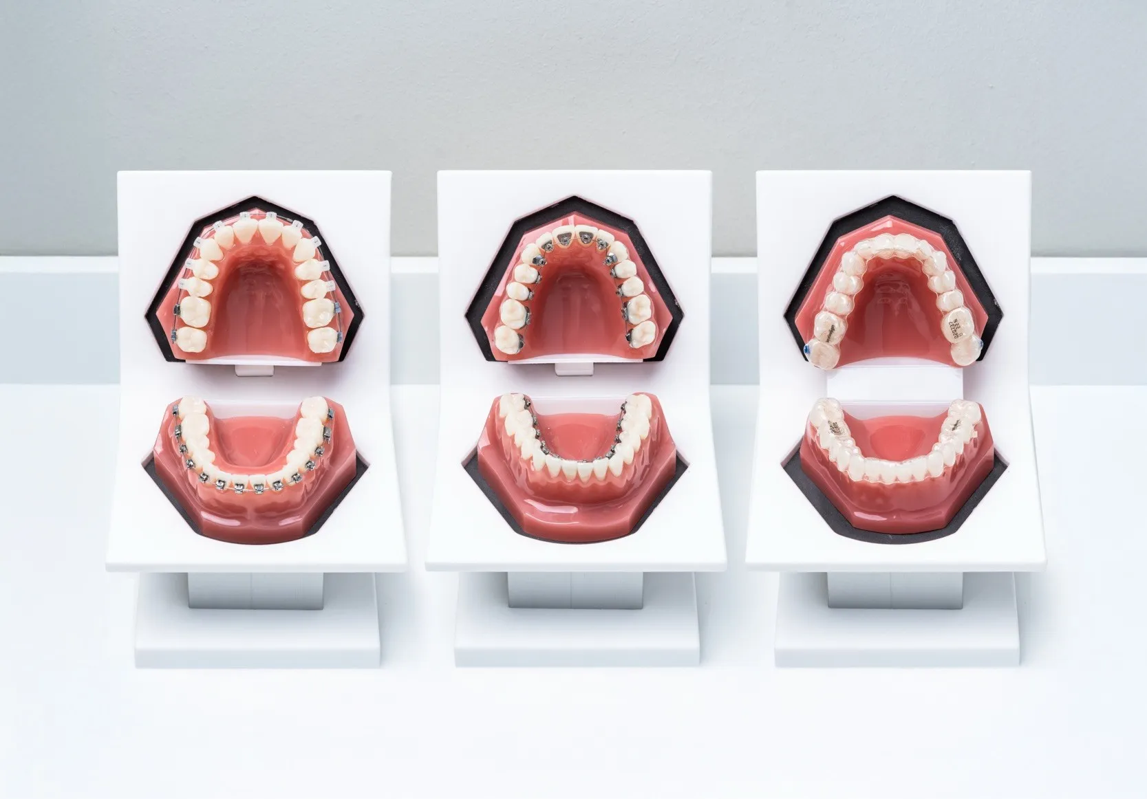 Kieferorthopädie für Erwachsene Dresden – unsichtbare Zahnkorrektur