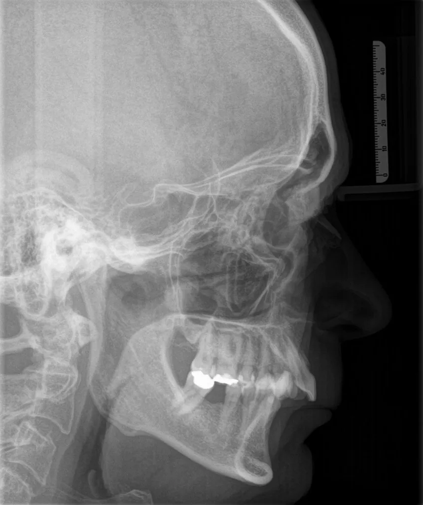 Röntgenaufnahme für kieferchirurgische Behandlungsplanung